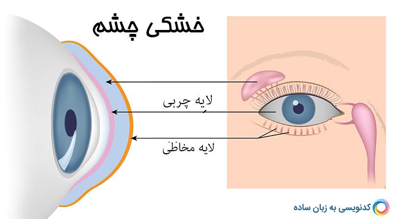 استفاده زیاد از کامپیوتر و ابتلا به عارضه خشکی چشم
