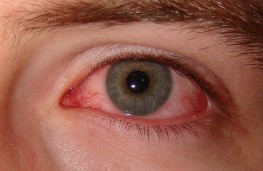 استفاده زیاد از کامپیوتر و ابتلا به عارضه خشکی چشم